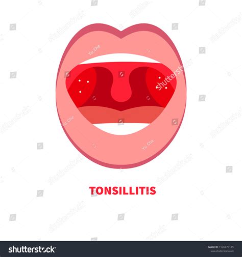 Tonsillitis Angina Sore Throat Cold Throat Stock Vector Royalty Free