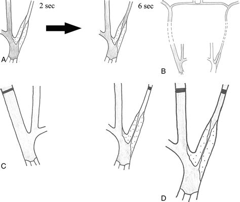 Carotid Near Occlusion A Comprehensive Review Part 1Definition