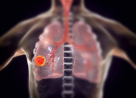 Merck Advances Atr Inhibitor Berzosertib In Small Cell Lung Cancer