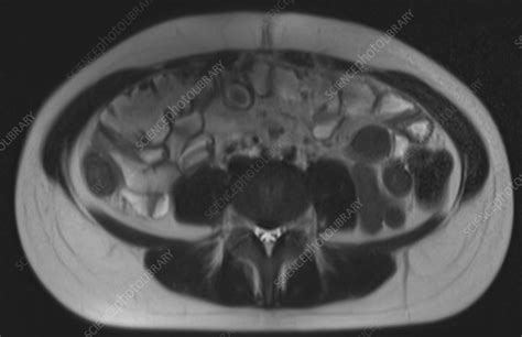 Normal Abdomen Lumbar Spine Sacrum Mri Stock Image C0393637