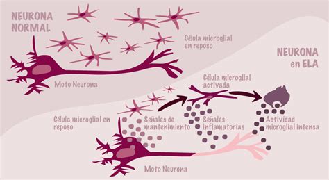 Se origina cuando las células del sistema nervioso llamadas motoneuronas disminuyen gradualmente su funcionamiento y mueren. Exposición sobre Investigación sobre en Enfermendades Raras: Esclerosis Lateral Amiotrófica
