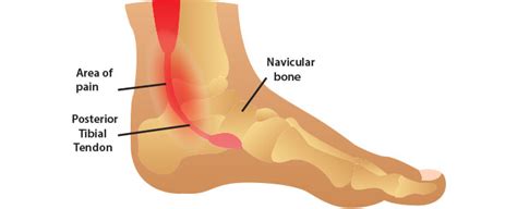 This enzyme that comes from pineapples reduces inflammation. Do you have Posterior Tibial Tendonitis? : Innovative Foot ...