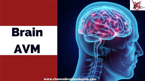 Brain Arteriovenous Malformationavm Symptoms Causes And Its