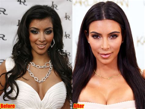 Kim Kardashian Face Surgery Before And After Photos 2018 Plastic Surgery Before And After