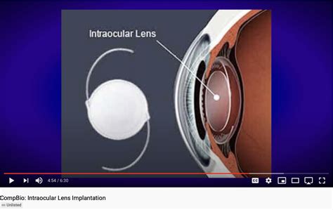intraocular lens implantation video comparative biosciences inc