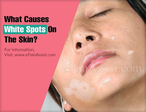 What Causes White Spots On The Skin