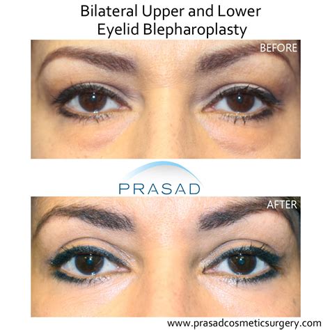 Eye Lift Before And After Photos Prasad Cosmetic Surgery Ny