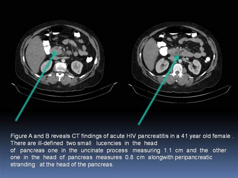 Normal Pancreas Ct Scan