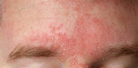 Skin Conditionsdermatitis Acne Concern