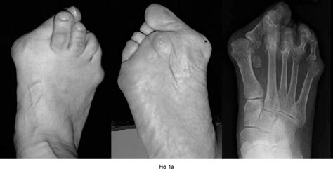 Figure 1 From Combination Joint Preserving Surgery For Forefoot