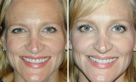 Botox can lift a drooping brow, but it has its botox cosmetic before and after photo gallery. Botox in Florida Treatment | Botox Florida Professional