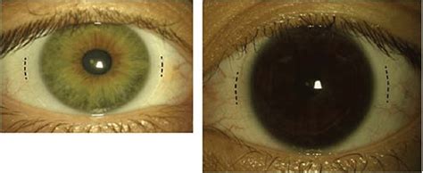 An Example Of A Good Soft Contact Lens Fit Demonstrating On Eye