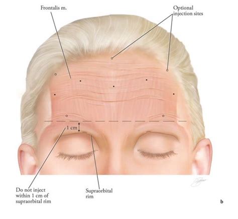Frontalis Facial Fillers Botox Fillers Botox Face