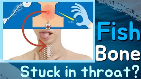 What To Do When A Fish Bone Gets Stuck In Your Throat Youtube