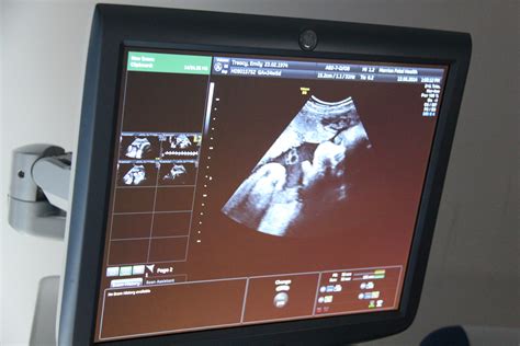 Screen Of Pregnancy Scan Merrion Fetal Health