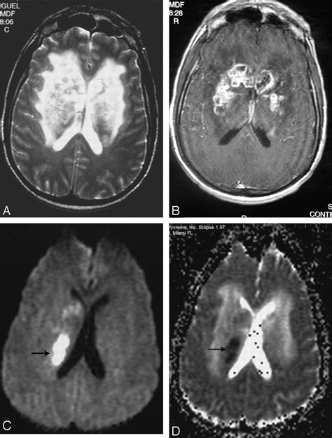 Unusual Presentation Of Central Nervous System Cryptococcal Infection