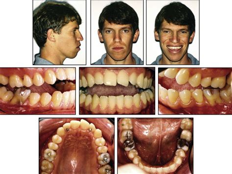 Treatment And Retreatment Of A Patient With A Severe Anterior Open Bite