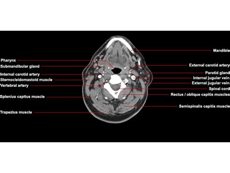 Axial Ct Anatomy Anatomy Mri Brain Parotid Gland