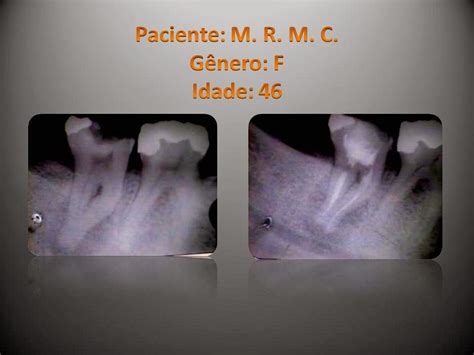 Endodontia Dr Henrique Braitt Tratamento endodôntico em molar Classe