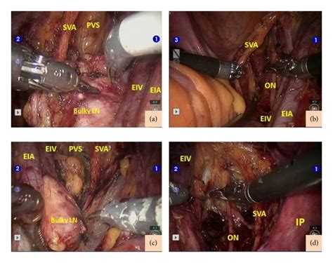 Robotic Assisted Dissection Of Bulky Lymph Nodes In Cervical Cancer