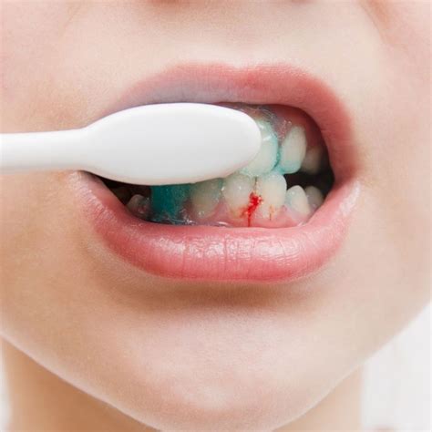 The Hidden Dangers Of Gum Disease Symptoms Treatment And Prevention