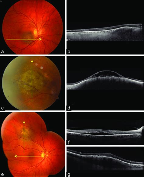 Choroidal tumors (pigmented). (a and b) Choroidal nevus (a ...