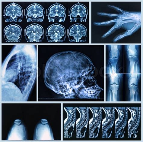 Radiography Of Human Bones X Ray And Stock Image Colourbox