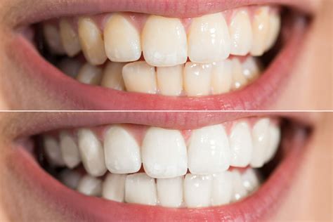 KÖr Teeth Whitening 1cosmetic Dentist In Houston Fms Dental