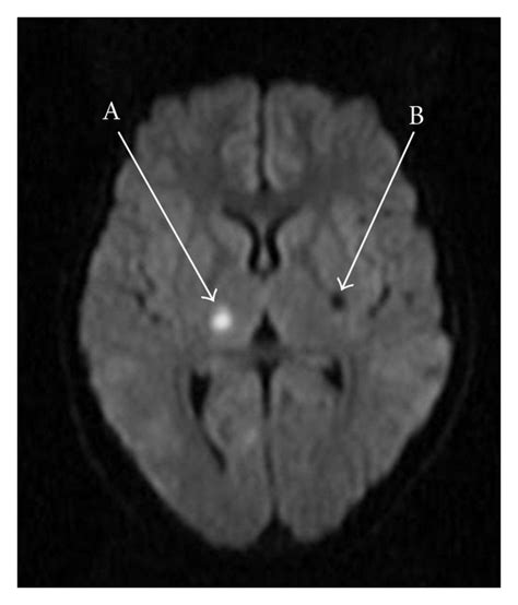 Diffusion Weighted Imaging Dwi Mri Of The Brain Showing An Acute Svi