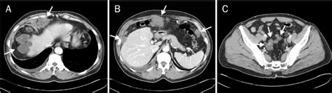 Axial Images Of Contrast Enhanced Abdomen Ct Demonstrated Conglomerated