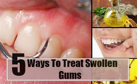 5 Best And Effective Ways For Swollen Gums Treatment Find Home Remedy