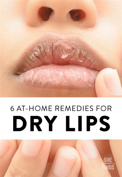 6 At Home Remedies For Dry Lips Dry Lips Remedy Dry Lips Chapped