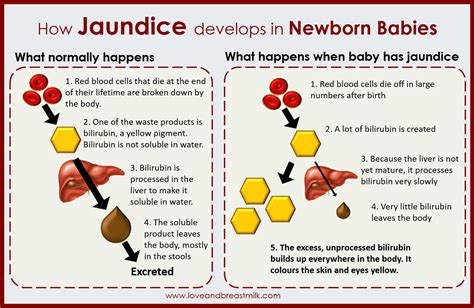Jaundice Infographic Neonatal Nurse Nicu Nurse Education Pediatric