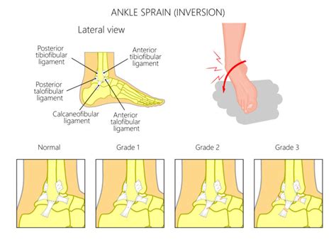 Strain Sprain First Aid Wiki
