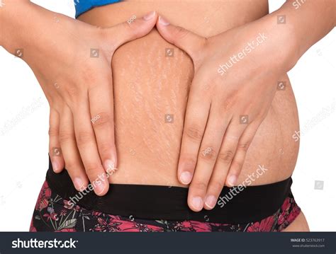 Women Body With Fat Belly And Stretch Marks Stock Photo 523763917