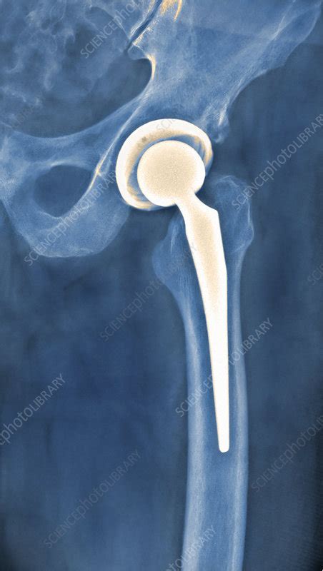 Total Hip Replacement X Ray Stock Image C0034815 Science