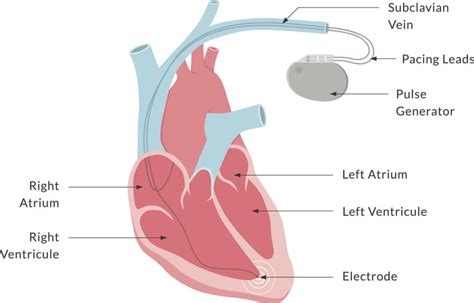 Pacemaker Insertion Procedure And Benefits Upmc In Central Pa