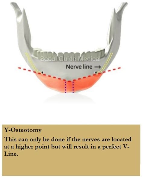 Genioplasty Your Guide To Chin Surgery In South Korea Seoul Guide