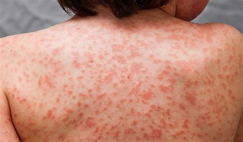Skin Rashes Are A Sign Of Coronavirus And Nhs Must Add Them To