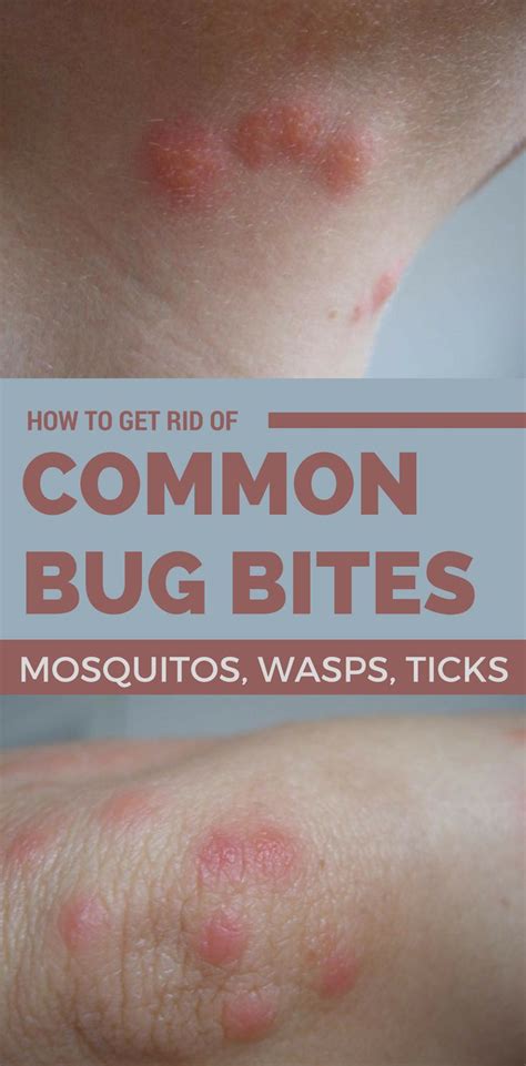 How To Get Rid Of Common Bug Bites Mosquitos Wasps Ticks Bug