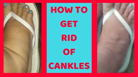 How To Get Rid Of Cankles No Surgery No Liposuction Youtube