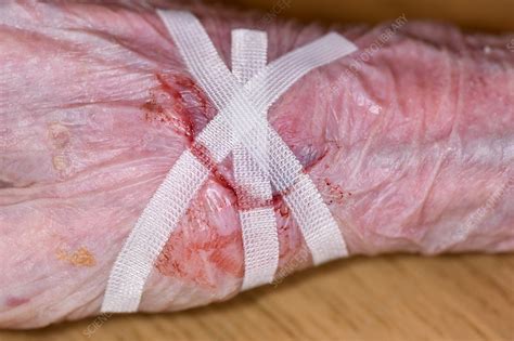 Hand laceration - Stock Image - C034/5523 - Science Photo Library