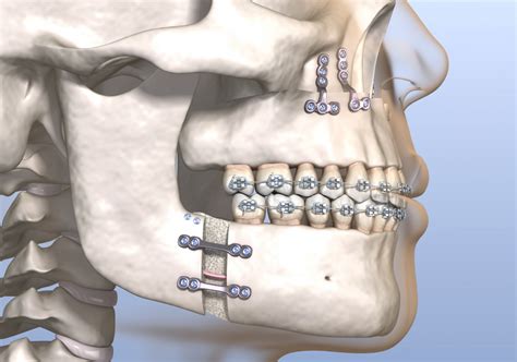 Corrective Jaw Surgery Provincial Oral Surgery