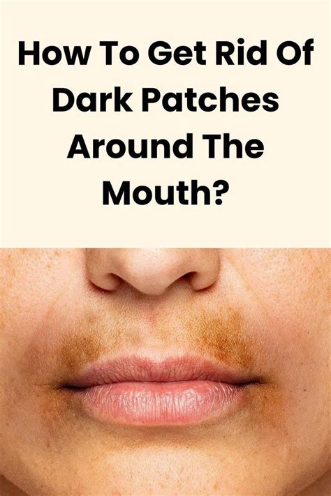 How To Get Rid Of Dark Patches Around The Mouth Dark Patches On Skin