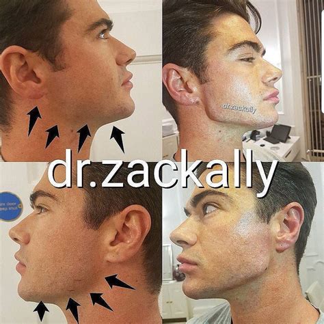 Masculinisation 👉learn How To Artistically Sculpt A New Jawline In 10