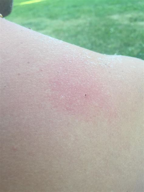 My So Got Bit By A Tick Yesterday Does This Look Bad We Took The Tick