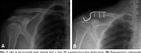 Figure 1 From The Necessity Of Coracoclavicular Ligament Repair In Open