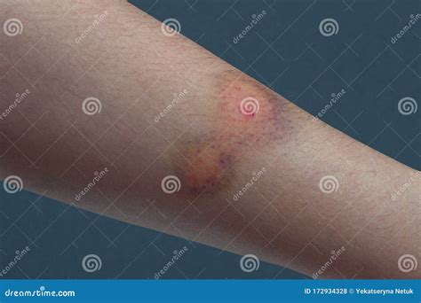 Close Up Of A Colored Bruise On A Woman Arm Stock Photo Image Of