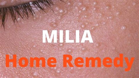 Milia Removal At Home