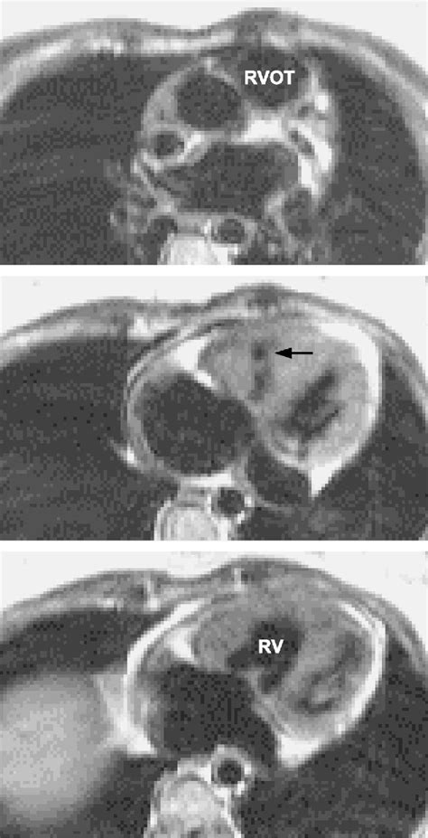 Figure 1 From Double Chambered Right Ventricle Or Sub Infundibular